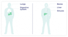 Image of How Cystic Fibrosis (CF) Affects the Bones, Liver, and Sinuses video