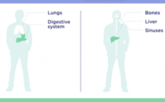 Image of How Cystic Fibrosis (CF) Affects the Bones, Liver, and Sinuses video