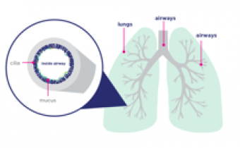 Image of How Cystic Fibrosis (CF) Affects the Lungs video