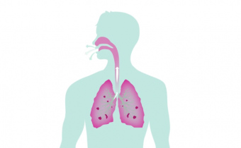Image of Cystic Fibrosis (CF) Progression in the Lungs video