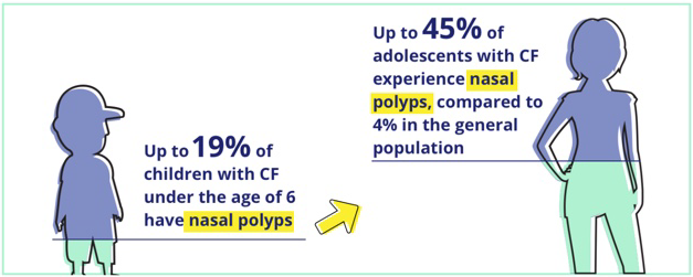 Up to 19% of children with CF under the age of 6 have nasal polyps. Up to 45% of adolescents with CF experience nasal polyps compared to 4% in the general population